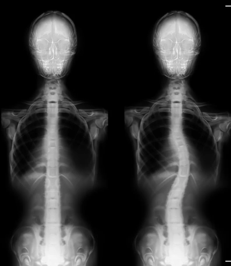 Scoliosis Wenatchee